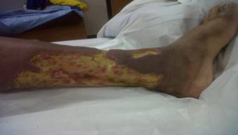 8 days after debridement. Maintaining the use of betamethasone/gentamicin. Granulation tissue is observed but edema persisting at the edges. This day the patient was discharged since clinical improvement was noticed, she was scheduled for outpatient follow-up