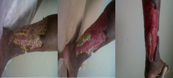 1 month after starting topical treatment. Abundant granulation tissue with fewer areas of fibrin, which was withdrawn with scalpel in the office, without presenting pathergy phenomenon