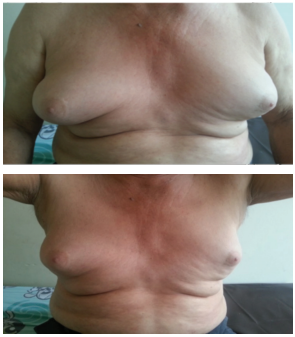 Fig 1. Ginecomastia grado 3.