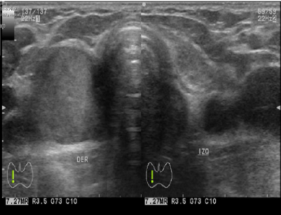 Ecografía en corte trasversal, se aprecia el lóbulo tiroideo
izquierdo normal y la lesión sospechosa ocupando el sitio anatómico del lóbulo
derecho con antecedente de extirpación
quirúrgica.