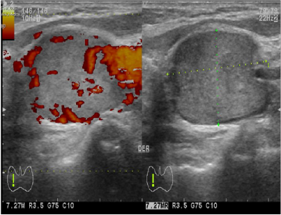  Eco tiroideo en corte transversal: A.- Véase la vascularización
periférica de la lesión al efecto doppler.B.- Véanse las características de la
lesión: heterogénea, hipoecoica, bordes regulares.