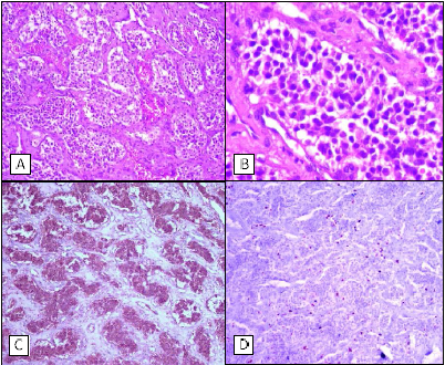A.- Patrón organoide, formado por nidos de células rodeadas por
tabiques de tejido conectivo vascularizado. HE, 100x. B.- Células de escaso citoplasma, núclos hipercromáticos, densos,
redondeados y pleomórficos. Tabiques de tejido conectivo. HE, 400x. C.- Sinaptofisina, positivo granular en
el citoplasma de las células neoplásicas. 40x. D.- Ki-67, índice de proliferación celular menor a 5%.