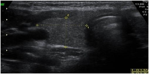 Imagen de ecografía preoperatoria: adenopatía de aspecto
necrótico-quístico de 16 mm adyacente al lóbulo tiroideo derecho.