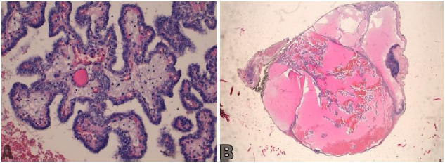 A: Papilas delimitadas por células, con núcleos superpuestos en vidrio
esmerilado con inclusiones y hendiduras. B: Visión global de la lesión de
naturaleza quística y rodeada de parénquima ganglionar