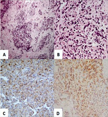 Microfotograf&iacute;a del paraganglioma de vesicular
seminal.