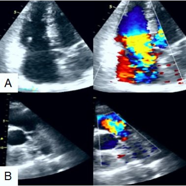 Im&aacute;genes del ecocardiograma bidimensional. A) Visi&oacute;n de las 4 c&aacute;maras. B) Visi&oacute;n del eje corto paraesternal con evidencia de c&aacute;maras cardiacas derechas dilatadas.