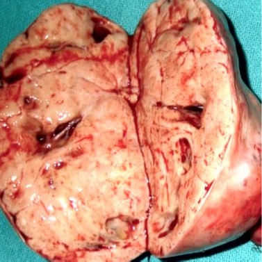 Secci&oacute;n transversal del tumor carcinoide de ovario.