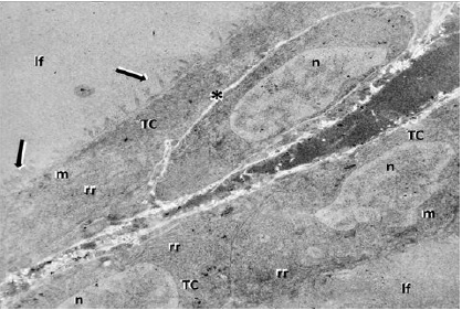 - C&eacute;lulas tiroideas (TC) de rata expuesta a malati&oacute;n. Es notoria la disminuci&oacute;n de la altura del epitelio, la reducci&oacute;n de organelas celulares y las alteraciones en la estructura de los n&uacute;cleos (n), llegando a haber retracci&oacute;n nuclear con aumento de la dimensi&oacute;n de la cisterna perinuclear (asterisco). rr, ret&iacute;culo endopl&aacute;smico rugoso; m, mitocondrias; lf, luz del fol&iacute;culo; flechas, microvellosidades. X3000.