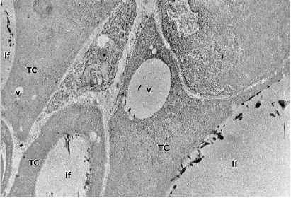 -En algunos grupos expuestos a malati&oacute;n se observ&oacute; marcado deterioro tisular con p&eacute;rdida de la organizaci&oacute;n celular. Los tirocitos (TC) adquieren formas irregulares y con signos de retracci&oacute;n; el citoplasma es homog&eacute;neo con ausencia de organelas y presencia de formaciones vacuoladas (v) o qu&iacute;sticas. La superficie luminal epitelial es lisa por la desaparici&oacute;n de las microvellosidades. lf, luz de fol&iacute;culo. X 3000.
