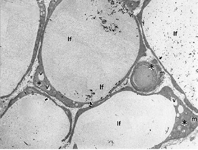 - La exposici&oacute;n de ratas al malati&oacute;n en algunos grupos de animales, produjo total atrofia celular. El epitelio folicular se hace laminar (flechas cortas) y en los sitios donde hay mayor volumen citoplasm&aacute;tico se ve la matriz celular condensada y homog&eacute;nea (asteriscos) con presencia de mitocondrias deterioradas (m) y vacuolas (v). Destaca la ausencia total de microvellosidades. lf, luz folicular. X 2000.