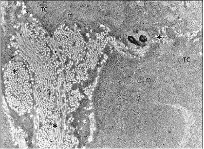 - Se observa con mayor detalle el deterioro tisular causado por la exposici&oacute;n a malati&oacute;n. Los espacios interfoliculares est&aacute;n invadidos por tejido fibroso tipo col&aacute;geno (asteriscos) y en el citoplasma de los tirocitos (TC) s&oacute;lo pueden distinguirse mitocondrias (m), quedando ocupado el resto del citoplasma por un material granular. X 7000.