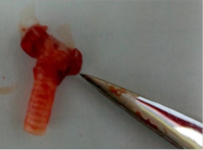 - Extracci&oacute;n de la gl&aacute;ndula tiroides con la tr&aacute;quea.