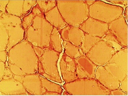 -Estudio histol&oacute;gico (tinci&oacute;n p-fenil-endiamina) de gl&aacute;ndula tiroides del grupo expuesto. Se observa hiperplasia difusa de c&eacute;lulas foliculares, los l&uacute;menes glandulares contienen grandes cantidades de coloide. Imagen con objeto de aumento 10X.