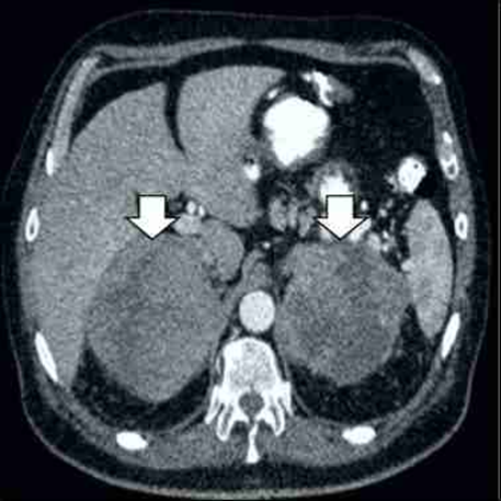 Im&aacute;genes de tomograf&iacute;a computada. Las flechas se&ntilde;alan tumores heterog&eacute;neos y necr&oacute;ticos en ambas gl&aacute;ndulas suprarrenales.