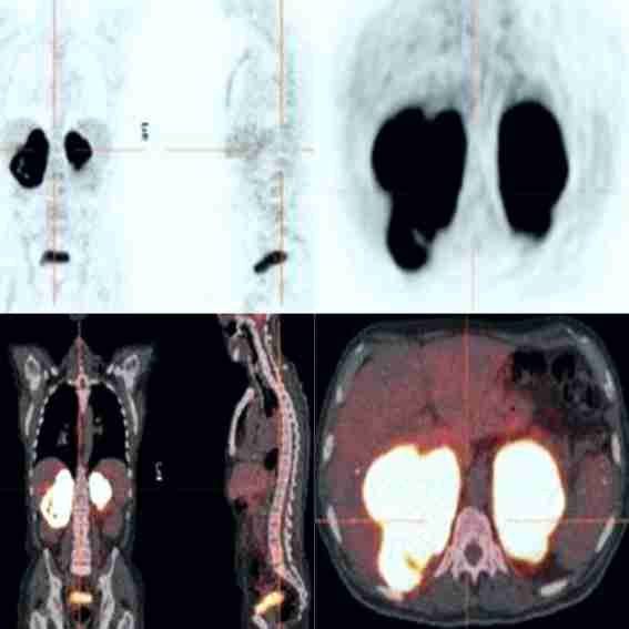 Imagen de tomograf&iacute;a por emisi&oacute;n de positrones que muestra intensa captaci&oacute;n de fluorodesoxiglucosa en ambas gl&aacute;ndulas suprarrenales.
