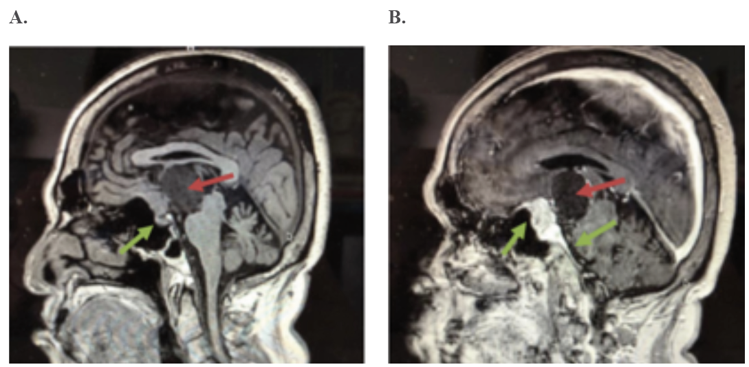 RMN en T1, corte sagital. A. Pre-contraste: se aprecia lesi�n hipodensa heterog�nea supraselar con extensi�n intraventricular (flecha roja). Se observa la gl�ndula hip�fisis indemne en sus dos porciones (flecha verde); la porci�n hiperintensa corresponde a la neurohip�fisis). B. Post contraste: Lesi�n heterog�nea qu�stica (flecha roja) sugestiva de craneofaringioma y lesi�n hiperdensa que capta contraste evidenci�ndose cola dural tanto en el plano esfenoidal como en el clivus en relaci�n a meningioma (flechas verdes).