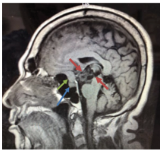 RMN cerebral posterior al drenaje del componente qu�stico del craneofaringioma. T1, corte sagital: se aprecia lesi�n heterog�nea, que muestra franca disminuci�n de su volumen en comparaci�n al preoperatorio. Restos del craneofaringioma y su c�psula (flechas rojas). Meningioma (flecha verde) e Hip�fisis (flecha azul)