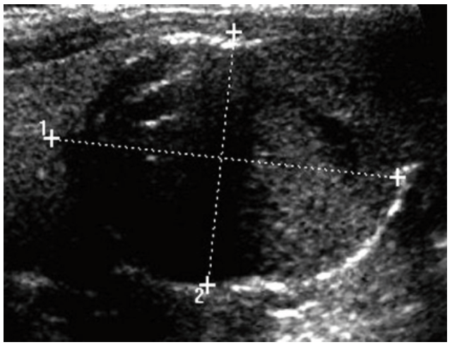 Imagen ecogr�fica del n�dulo tiroideo heterog�neo de 35 mil�metros de di�metro en el l�bulo izquierdo.