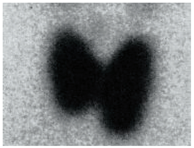 Gammagraf�a con 99mTecnecio de gl�ndula tiroides que muestra incremento difuso de la captaci�n en ambos l�bulos tiroideos con un aumento de la captaci�n focal en el l�bulo izquierdo, correspondiente al n�dulo tiroideo detectado por ecograf�a.