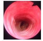 Endoscopia traqueal libre de lesión