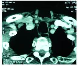 Imagen tomográfica de lesión