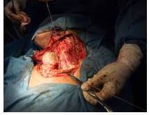 Sección clavicular