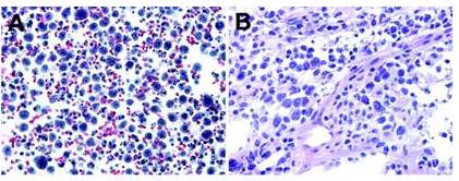Linfoma Primario de Efusión. (A):
células positivas para el VHH-8 con técnica Inmunohistoquímica. (B): biopsia
pleural con H&E (400x) mostrando células pleomórficas grandes con nucléolos
prominentes y contornos nucleares irregulares