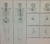 Gammagrama &oacute;seo. 