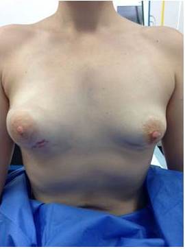 Mama derecha con masa
tumoral en unión de cuadrante ínfero externo