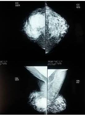 Mamografía fibroglandular densa en la
que se observa una masa redondeada visible con bordes irregulares en cuadrante ínfero
externo.