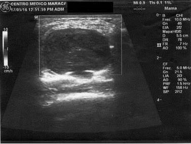 Mama con tejido
fibro-ductal con distribución difusa, imagen nodular dominante de aspecto sólido
en mama derecha hipoecogénica ovalada con fino septo lineal a nivel de
cuadrantes ínfero externo