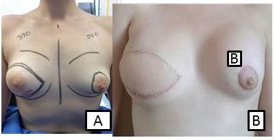 A: Marcaje de
la paciente para practicar la mastectomía total simple y planificación de la
reconstrucción B: Resultado del posoperatorio inmediato.