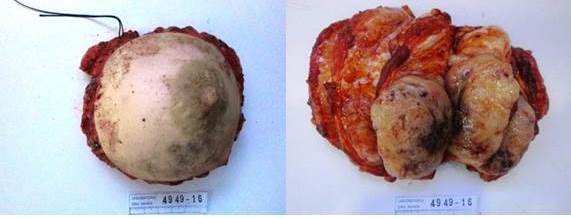 Pieza de mastectomía total simple, Tamaño tumoral: 16,3 cm. Bordes libres de
tumor.
