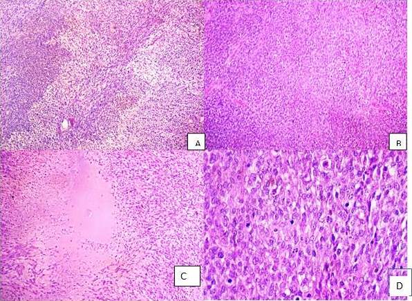 Microfotografías
de la lesión en hematoxilina-eosina A:
Presencia a áreas más celulares alternando con áreas menos celulares. Aumento
100 x. B: Áreas densamente celulares
con presencia de células de aspecto epitelioide. Aumento 100 x. C:
Áreas de necrosis con empalizada de núcleos neoplásicos. Aumento D: Elevada actividad mitótica. Aumento
400