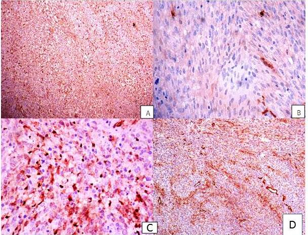 Microfotografías de las diferentes
inmunorreacciones A: VIMENTINA, con marcaje citoplasmático
difuso fuerte de las células neoplásicas. Aumento 100x B: PROTEÍNA S100 con
positividad citoplasmática y nuclear en aisladas células neoplásicas. Aumento
400x C: ENOLASA positividad
citoplasmática granular en algunas células neoplásicas. Aumento 400x. D: CD34 positividad multifocal de
membrana citoplasmática en las células neoplásicas. Aumento 100x.