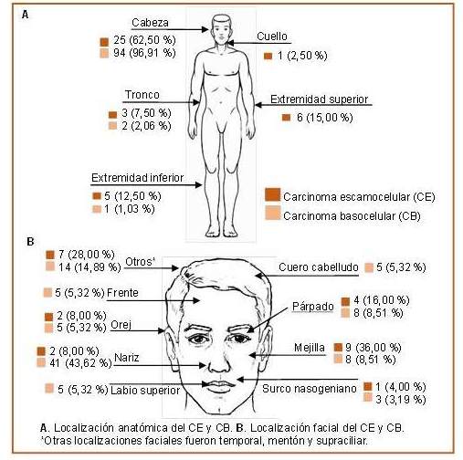 Frecuencia de localización anatómica según el tipo
de NPNM confirmado por anatomía patológica en Hospital Regional
Lambayeque. Enero 2015- Julio 2016  

                                 