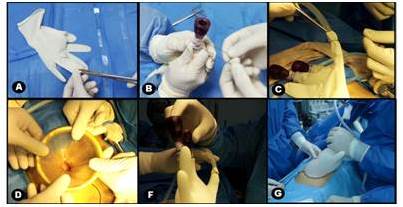 Pasos para la
elaboraci&oacute;n del glove port artesanal. A. Corte del guante de l&aacute;tex con tijera
Mayo. B. Introducci&oacute;n y fijaci&oacute;n de trocares. C. Fijaci&oacute;n de manguera de
insuflador de di&oacute;xido de carbono. D. Introducci&oacute;n del dispositivo Alexis&reg;.
F. Insuflaci&oacute;n de CO2 hasta 12 mmhg. G.
Introducci&oacute;n de c&aacute;mara.