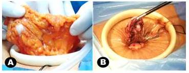 Exposici&oacute;n
del epipl&oacute;n mayor (A) y extracci&oacute;n de quiste de ovario (B) a trav&eacute;s del
dispositivo.