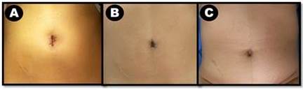  A y B. Paciente de 21 a&ntilde;os con tumor de
ovario borderline a quien se le realizo protocolo de ovario preservador de
fertilidad (apendicetom&iacute;a y laparotom&iacute;a ginecol&oacute;gica previa). Posoperatorio
inmediato (a) y posoperatorio de 7 d&iacute;as
(b). C. Paciente femenino de 61 a&ntilde;os con antecedentes de diabetes mellitus y
cirug&iacute;a previa p&eacute;lvica, se realiz&oacute; cirug&iacute;a estadiadora de endometrio, foto con
12 meses posterior a cirug&iacute;a. 

 