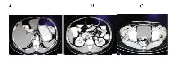 TAC de abdomen y pelvis A.
Corte axial. B y C. Cortes axiales inferiores.