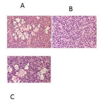 A, B y C.- Nódulo del estroma endometrial con
áreas de infarto, 4 mitosis en 10 campos de gran aumento. 

 