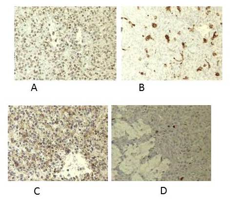A.-CD10
Positivo. B.- CD68 positivo en macrófagos C.-RP positivo D.-
Ki67 positivo 5 %
