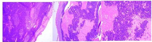 C&eacute;lulas escamosas
de aspecto basaloide, con &aacute;reas s&oacute;lidas y qu&iacute;sticas. Compatible con carcinoma
branquig&eacute;nico o branquioma. 

 