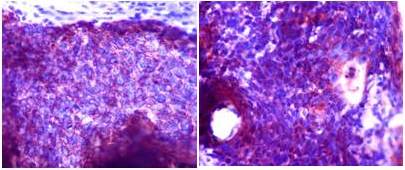 Inmunohistoqu&iacute;mica, positivo para citoqueratina 34BE12, P63 y citoqueratina
7.
