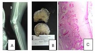 Osteocondroma
    s&eacute;sil. A. Estudio radiol&oacute;gico. B. Pieza macrosc&oacute;pica  C.
    Hematoxilina-eosina. Aumento 10X