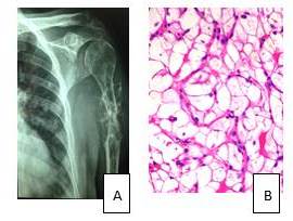 Carcinoma de
c&eacute;lulas renales metast&aacute;sico.