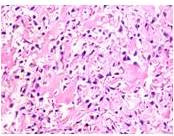 Osteosarcoma convencional. Hematoxilina-eosina. Aumento 40X
