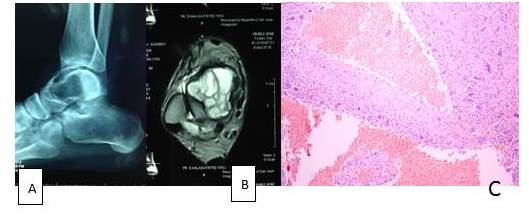 Quiste &oacute;seo
aneurism&aacute;tico. A. Estudio radiol&oacute;gico. B. Resonancia magn&eacute;tica. C.
Hematoxilina-eosina. Aumento 40 X 

         

 