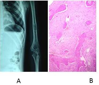 Displasia fibrosa. A. Estudio radiol&oacute;gico. B. Hematoxilina-eosina. Aumento 40 X