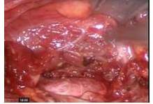 Vena yugular interna VYI en la parte inferior y m&uacute;sculo esternocleidomastoideo
(ECM), superiormente